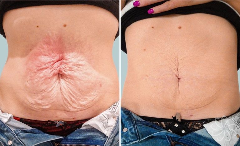 Techniques for Sustainable Skin Tightening Without Invasive Surgery