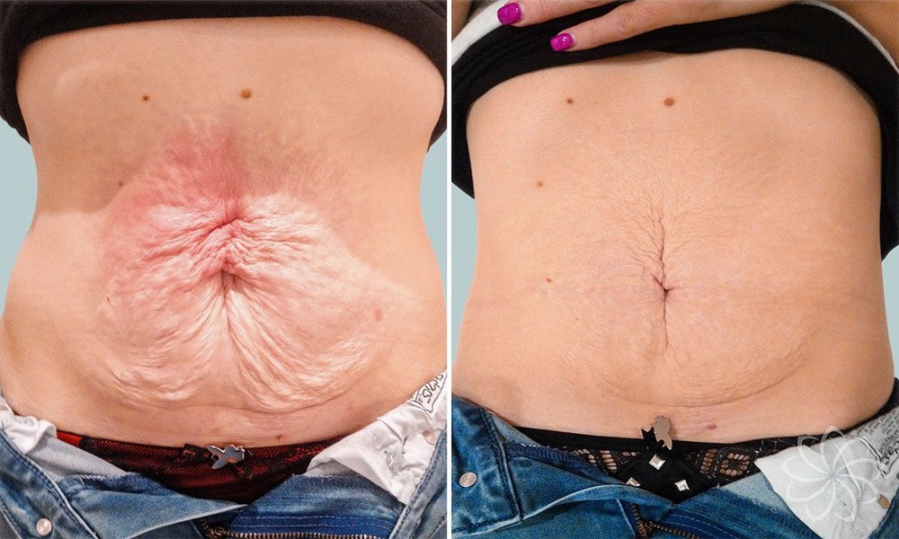 Techniques for Sustainable Skin Tightening Without Invasive Surgery