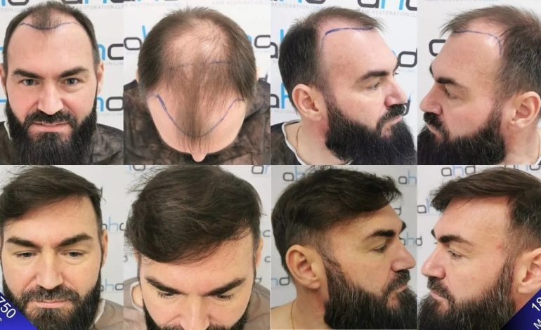 Hair Transplant Turkey Before and After