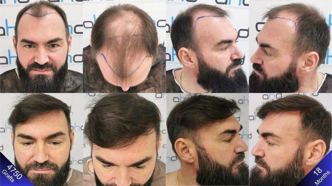 Hair Transplant Turkey Before and After